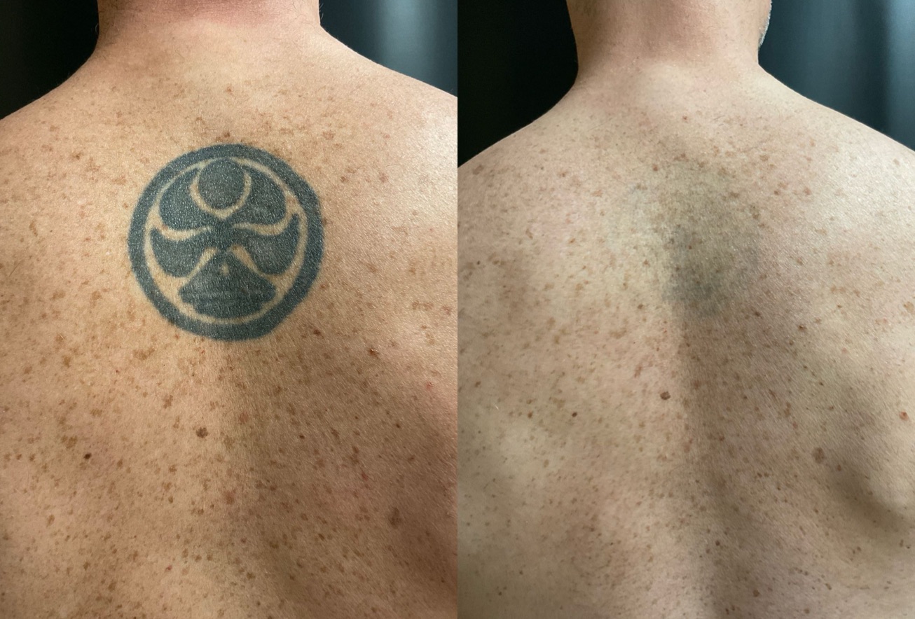 Laser Tattoo Removal