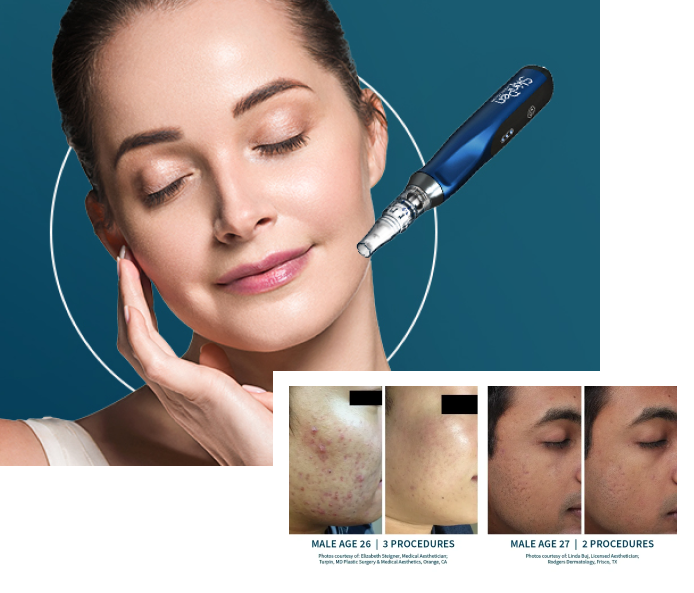 Acne Treatments