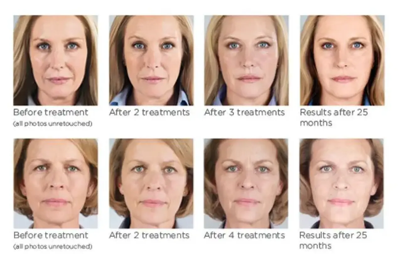 Sculptra Aesthetic