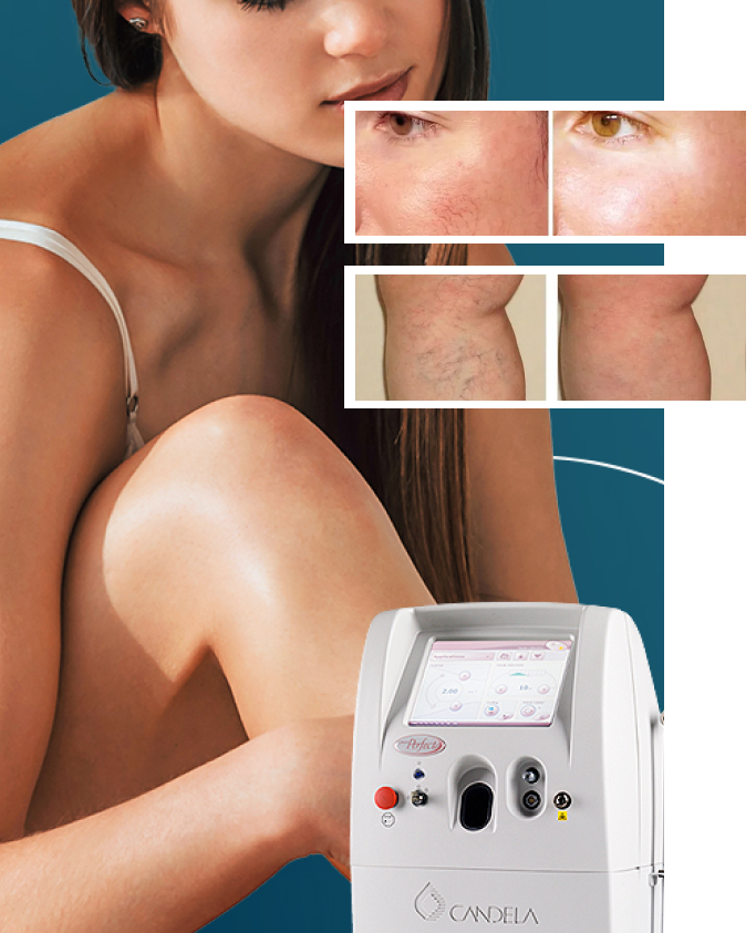 Vbeam Perfecta Treatment