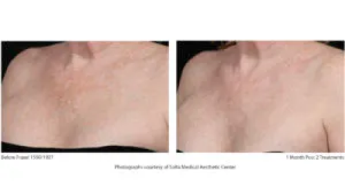 Before & After Juvenation