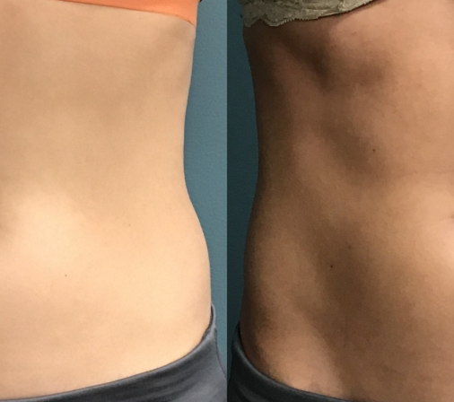 Body Contouring