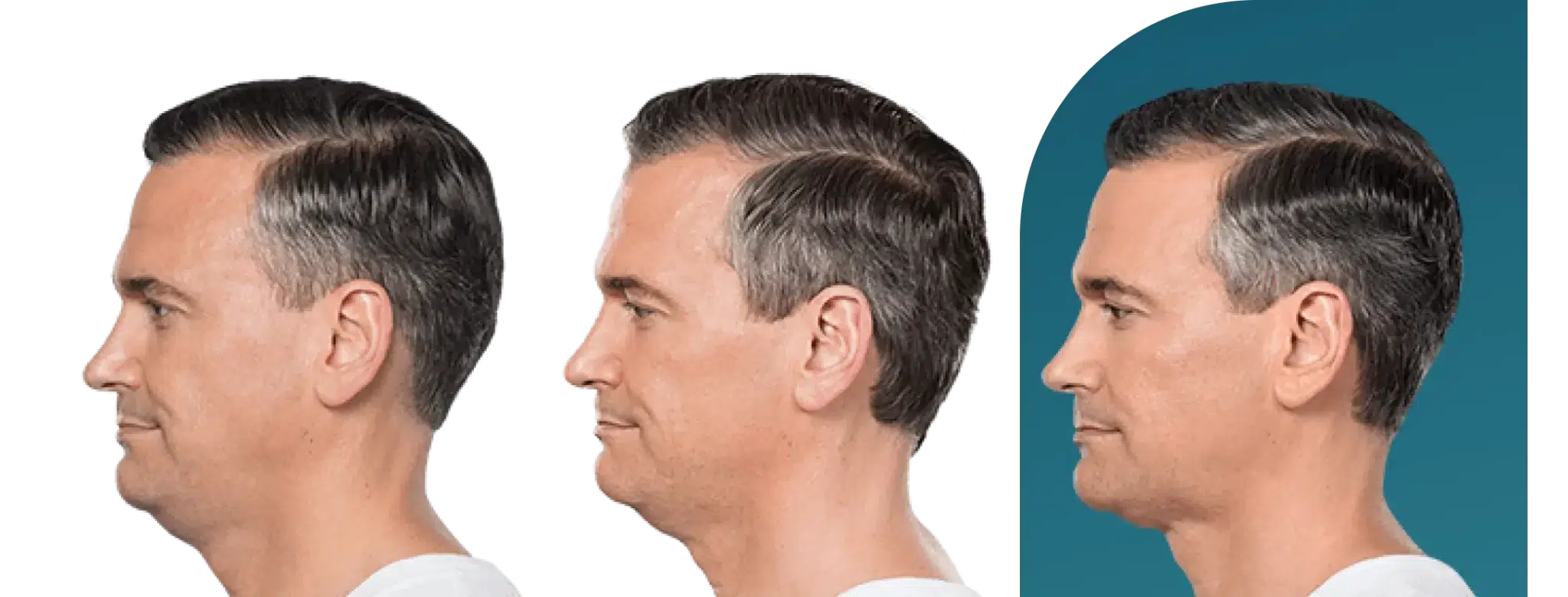 kybella