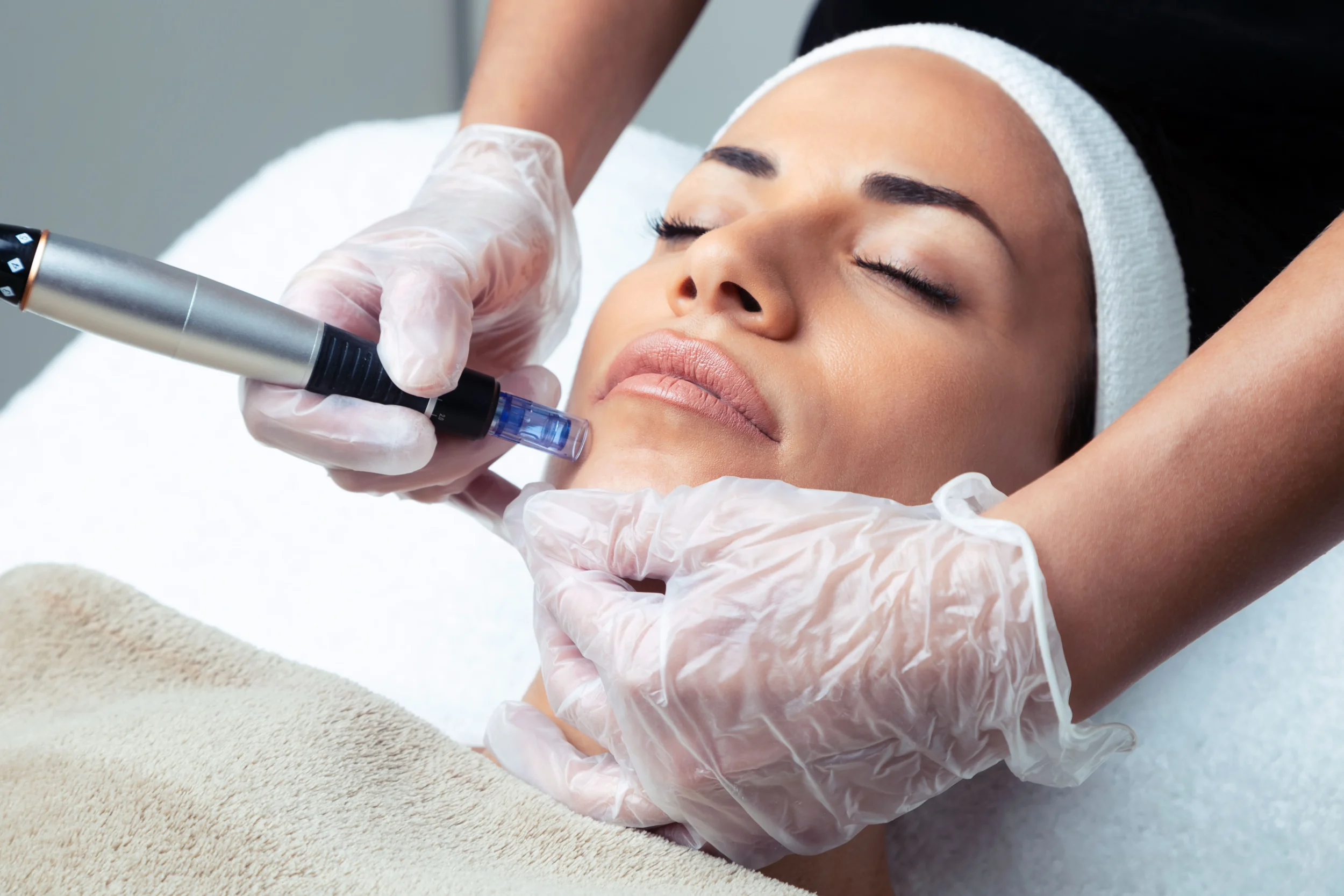 A gloved esthetician performing a microneedling procedure on a womans face as the best treatment for acne scarring in a professional clinic 1