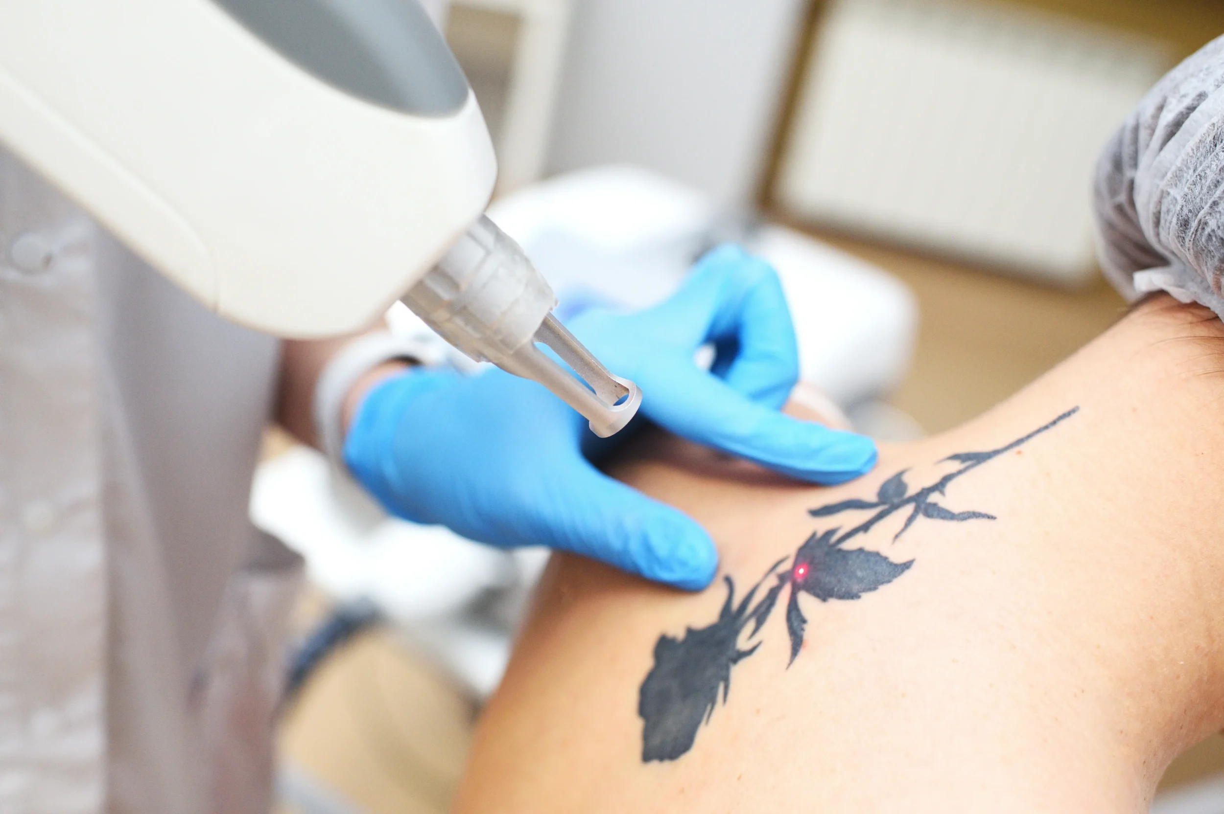 getting-a-tattoo-removed