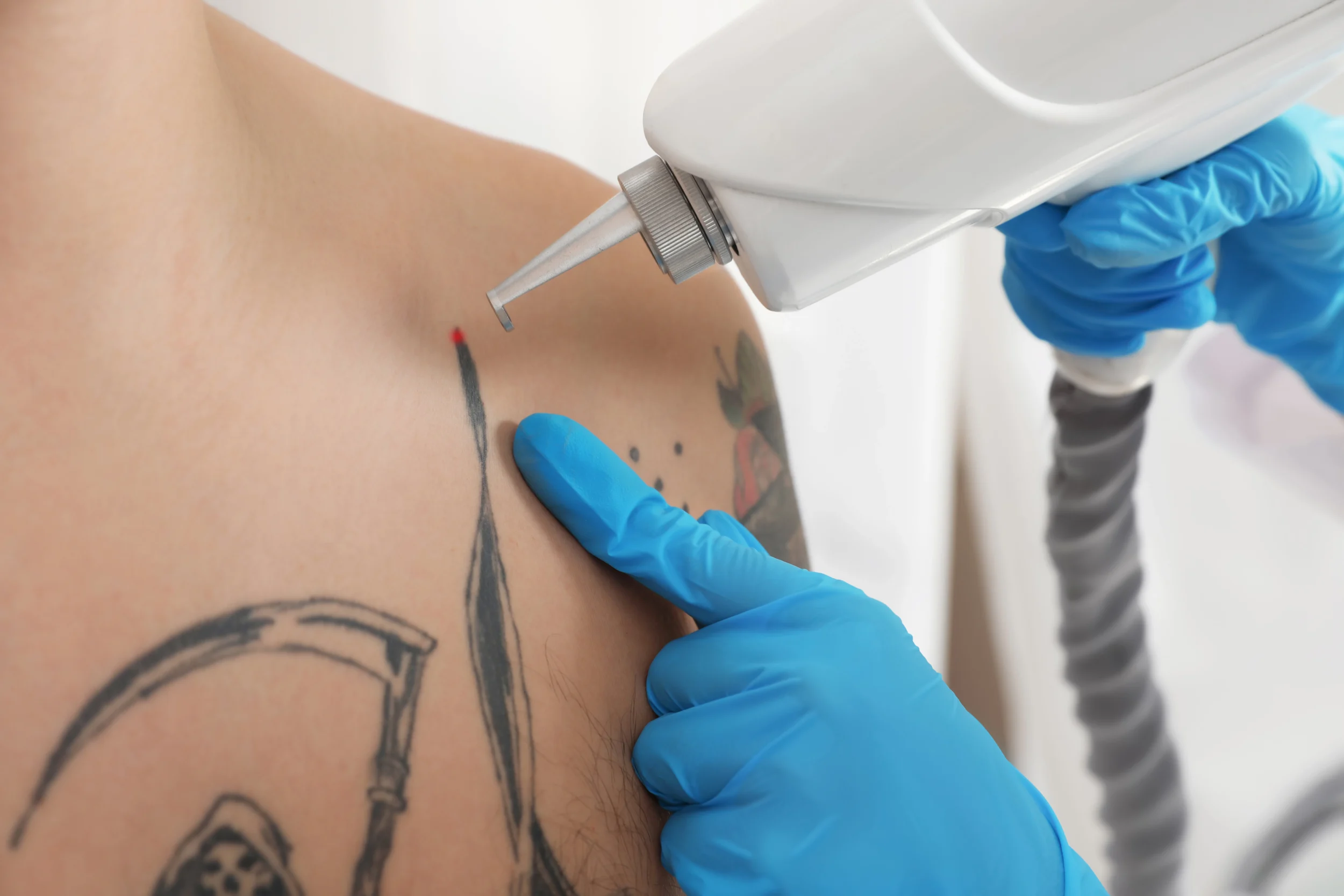 tattoo-removal